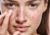 Comprendre les boutons sur le visage : Causes, traitements et prévention