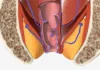 Comment savoir si j'ai des hémorroïdes ou une fissure anale ?